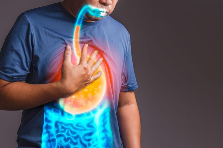 Gastroesophageal Reflux Disease (GERD)