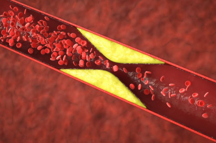 Hyperlipidemia