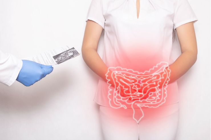 Irritable Bowel Syndrome (IBS)