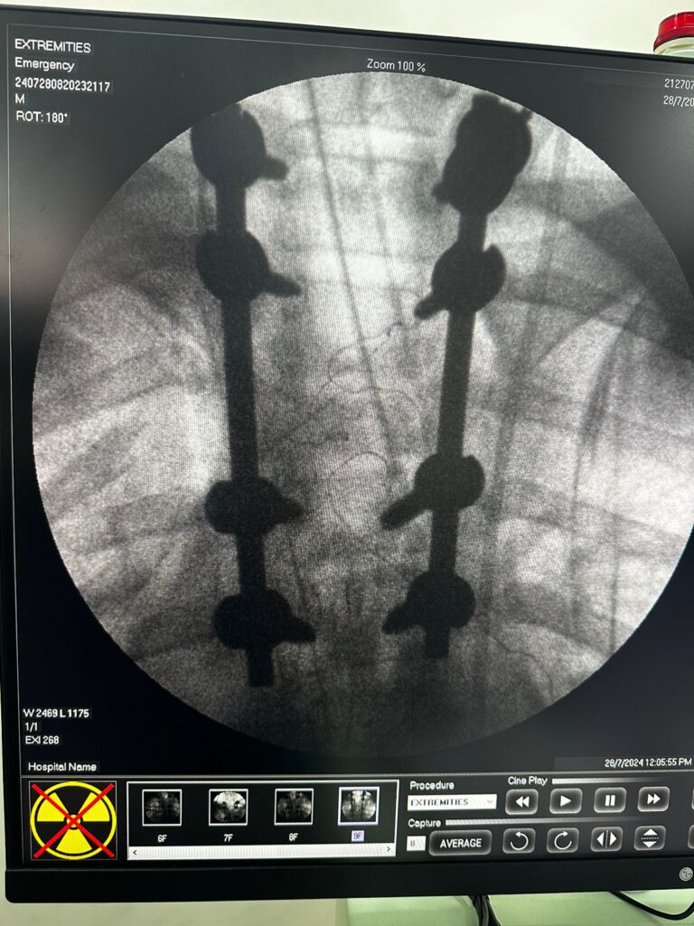 Spine-Case