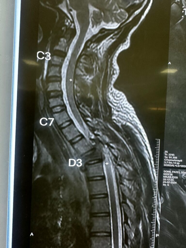 Spine-Case